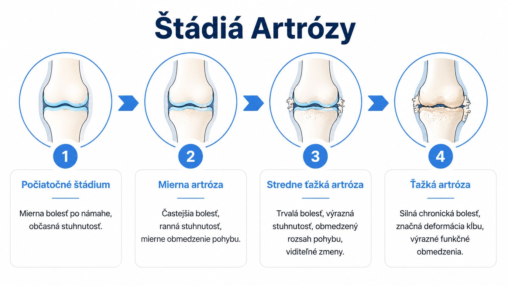 Informačná grafika zobrazujúca štyri štádiá vývoja artrózy, od počiatočných zmien až po ťažkú deformáciu kĺbov.