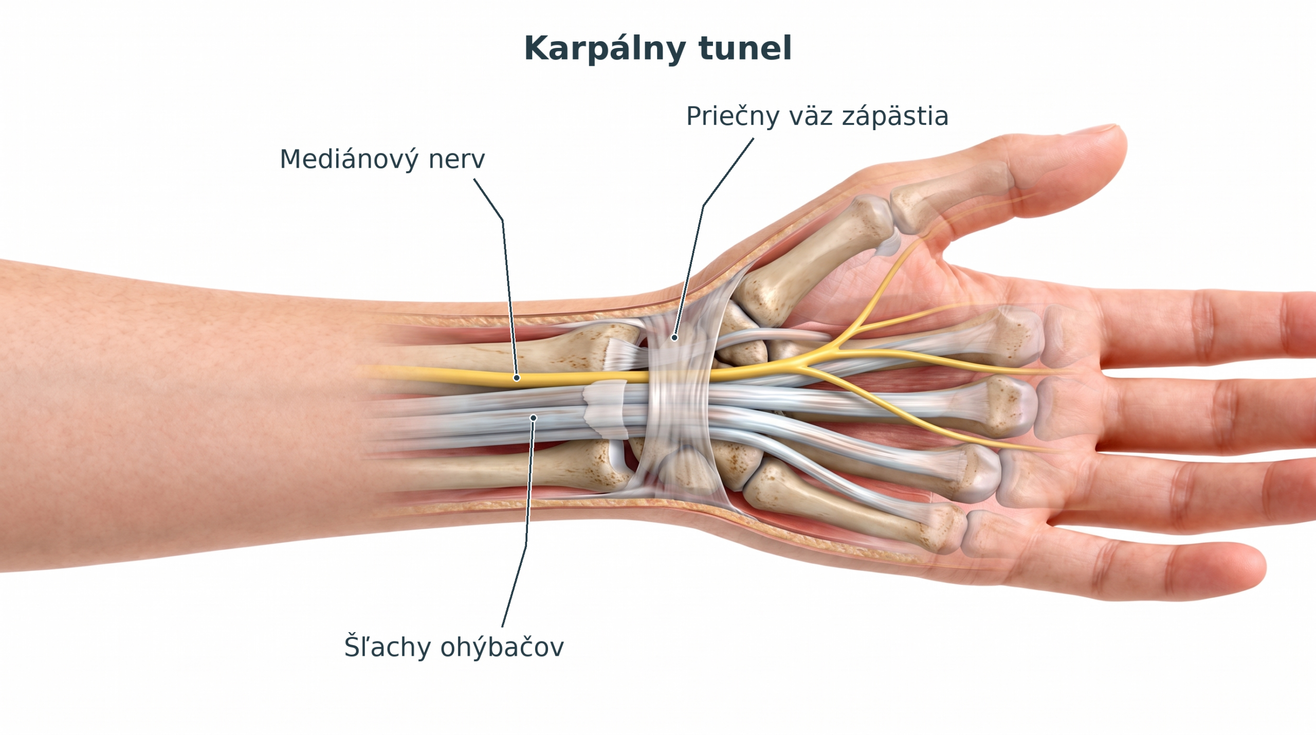 Detailný prierez zápästia ukazujúci mediánový nerv a karpálny tunel. Červené oblasti signalizujú zápal.